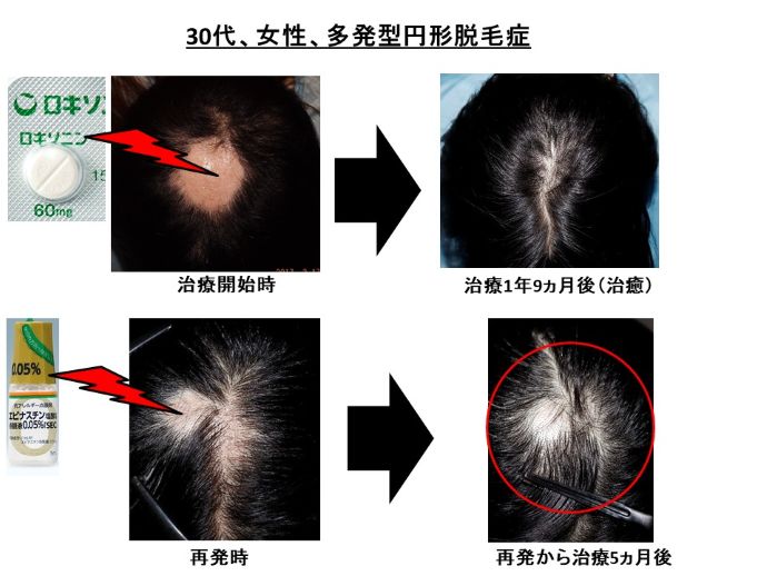 円形脱毛症　病院
